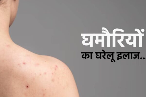 Warmth Rash Dwelling Cures: In case you are troubled by prickly, then undertake these residence treatments, you’re going to get aid instantly!
