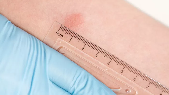 ICMR Approves Indigenous Kit for Simpler TB Testing